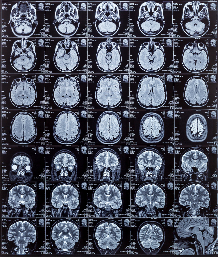 MRI of brain for Alzheimer's.